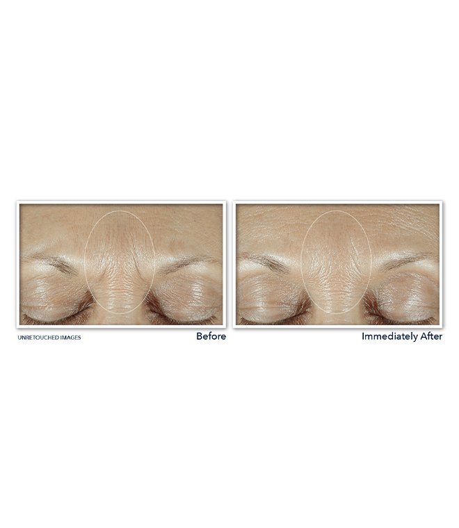 DERM CORREXION Fill Treat Serum RoC Australia Buy Now RoC Derm correxion fill treat serum roc australia buy now roc