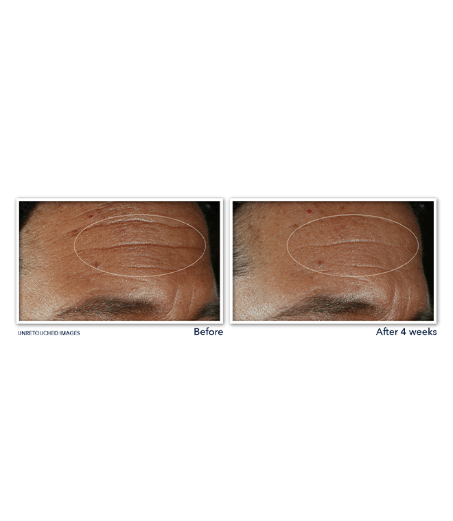 DERM CORREXION Fill Treat Serum RoC Australia Buy Now RoC Derm correxion fill treat serum roc australia buy now roc